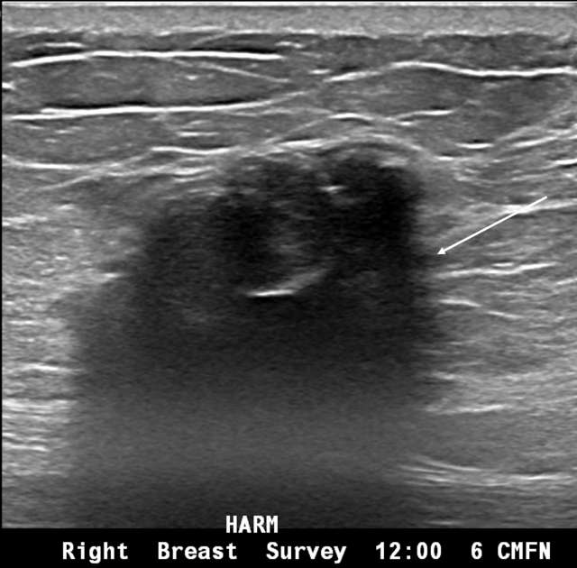 Areas of calcified fat necrosis.