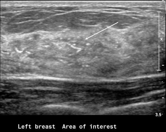 Areas of calcifications without associated abnormal sonographic findings in the surrounding breast tissue
