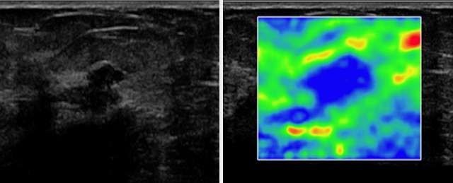 Elastography and irregular borders