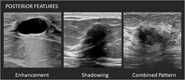 Ultrasound Mass Posterior Features