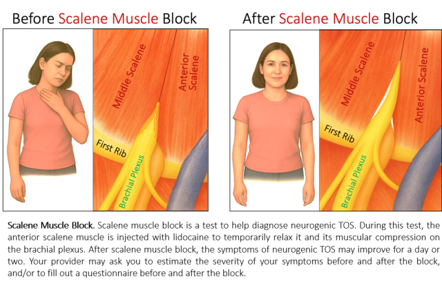 Scalene Muscle Block Before and After Diagram