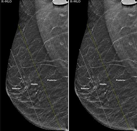 Screening Mammogram: Breast Lesion Localization Figure 7