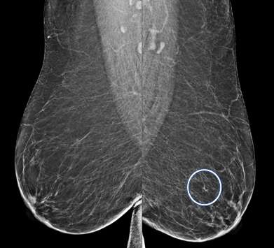 MLO views of the breast demonstrate an asymmetry in the left subareolar breast, middle depth. This finding is called an asymmetry if there is no corresponding finding on the CC view.