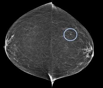 CC views of the breast of the same patient as above demonstrate a correlate to the asymmetry seen on MLO view. This is now a focal asymmetry of the left breast at 3 o’clock.