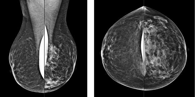 Implant displaced MLO and CC views of the breast demonstrate increased density through the left breast, consistent with a global asymmetry.