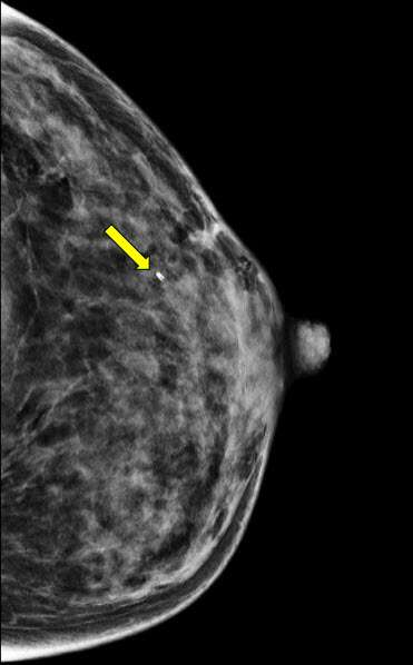 Procedure MRI Guided Breast biopsy Figure 4