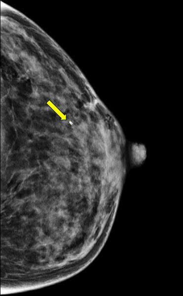 Procedure MRI Guided Breast biopsy Figure 4