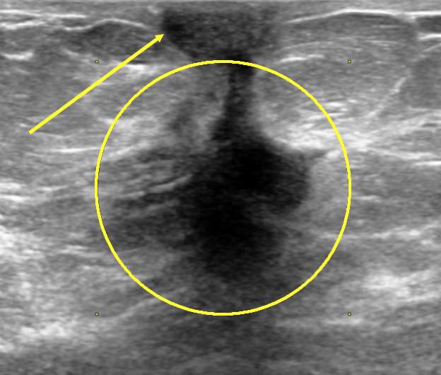 Case: Skin and Nipple Changes Figure 4