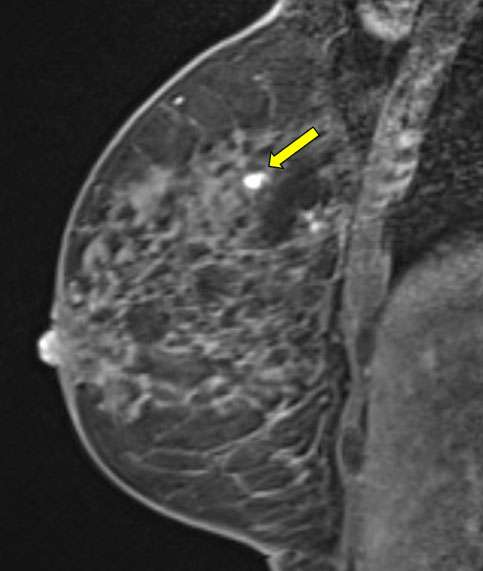 Procedure MRI Guided Breast biopsy Figure 2