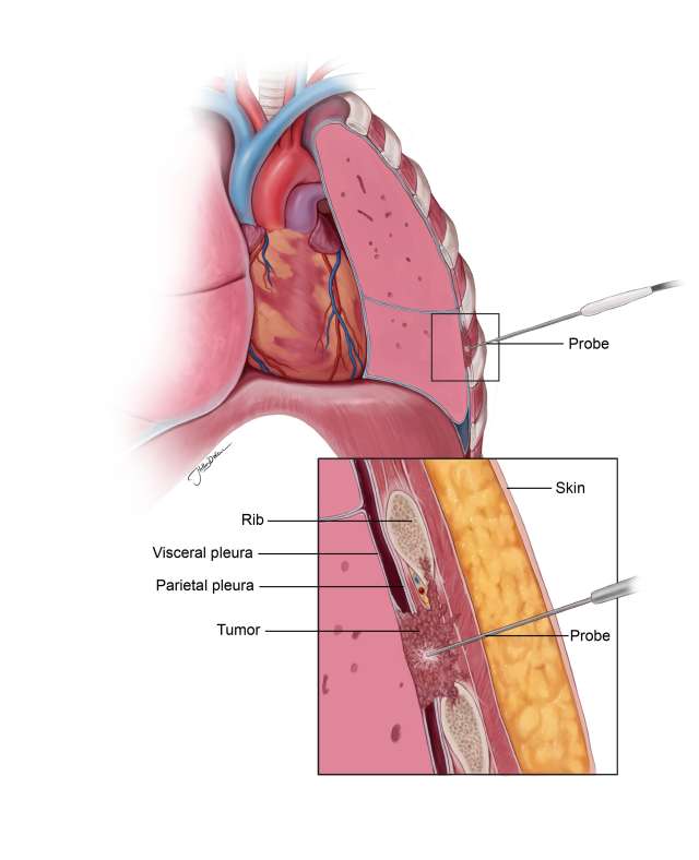 Anatomical illustration of the heart and surrounding pleura structures, labeled parts included.