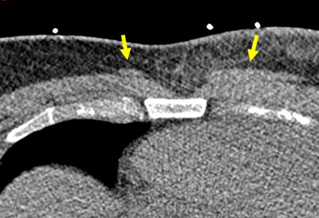 Case Sternalis Muscle Figure 1