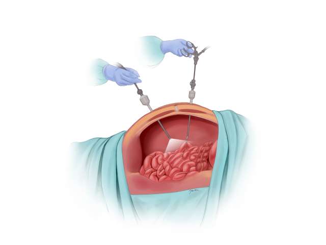 Surgical illustration showing hands holding instruments above an opened abdomen.
