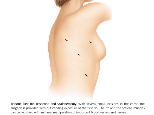 Robotic First Rib Resection and Scalenectomy Diagram