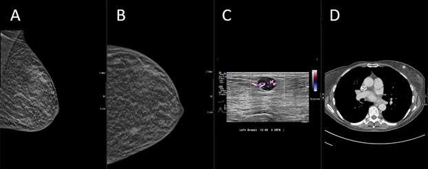 Case: Metastasis to the Breast From a Non-breast Primary Cancer Figure 3
