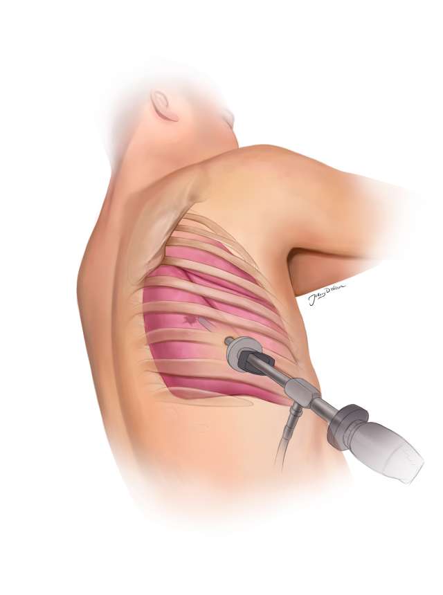 Anatomical illustration of a ribcage with muscle detail and a surgical tool.