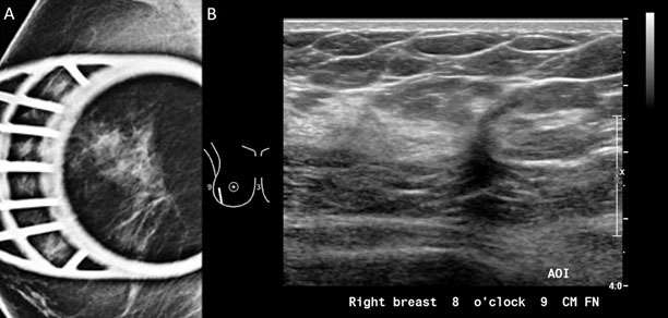 Mammography: Masses Figure 6