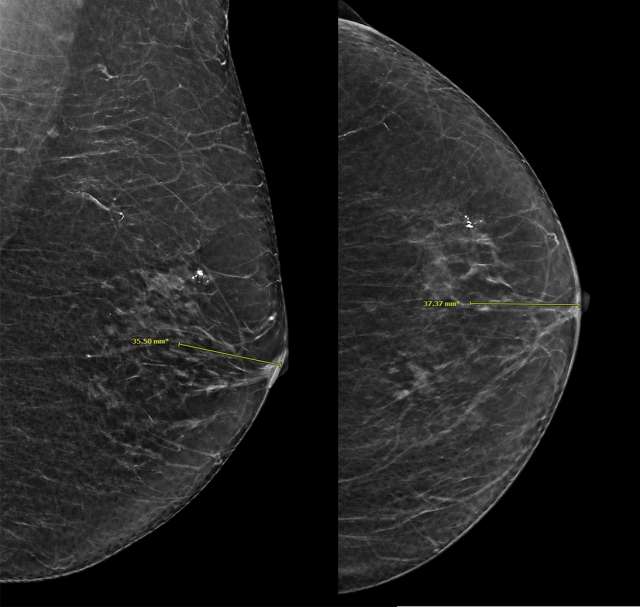 Screening Mammogram: Breast Lesion Localization Figure 8