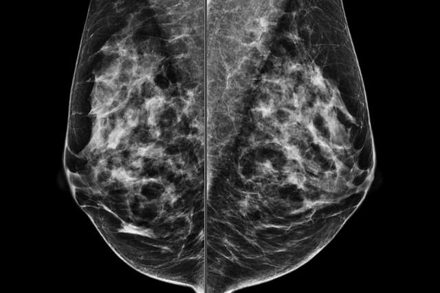Screening Mammogram