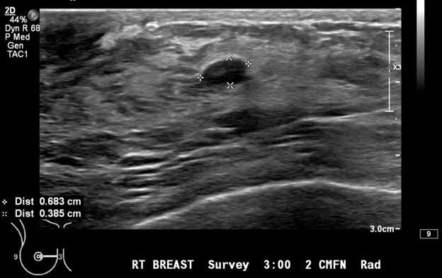 Mammography: Masses Figure 1