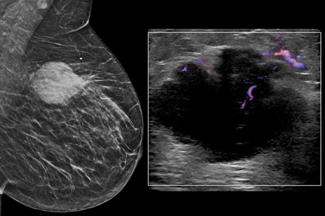 UCLA Radiology Breast Imaging Teaching Resources: Cases