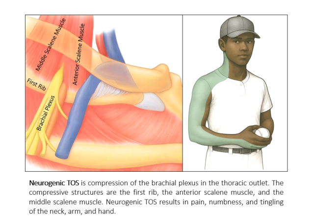 Neurogenic TOS Diagram
