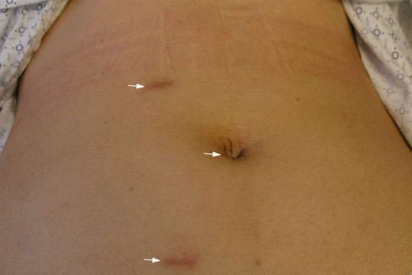 Scar advanced laparoscopic surgery for extra-adrenal pheochromocytoma