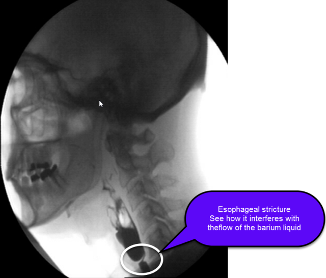 Esophageal Stricture Esophageal Health UCLA Health