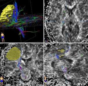 Advanced Imaging and Brain Mapping - Pituitary & Skull Base Tumor ...