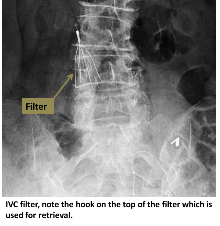 IVC Filter Placement IVC Filter UCLA Health