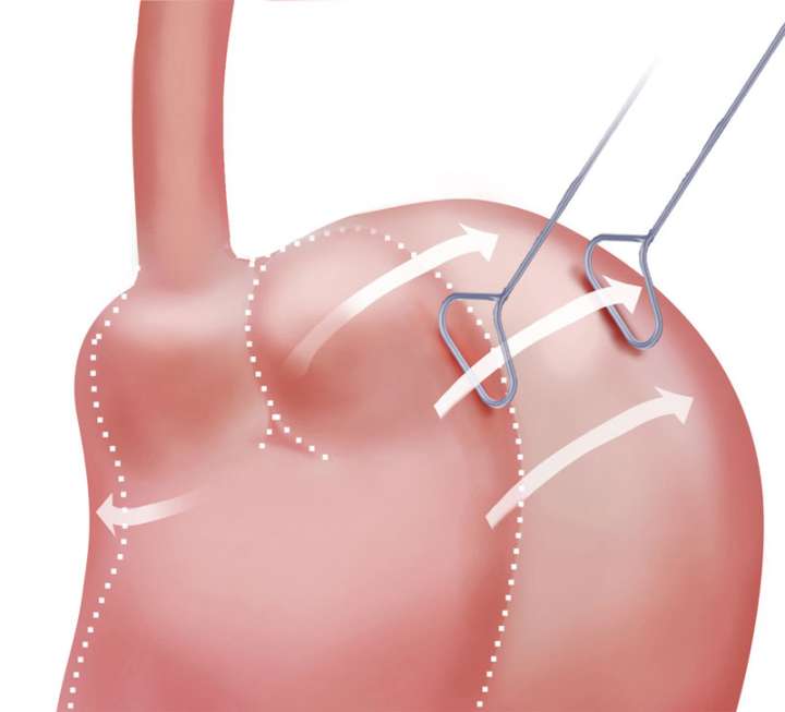 Lap Band Removal Bariatric Surgery UCLA Health