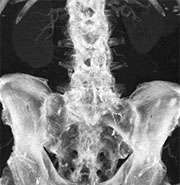 Dual Energy CT Angiography - Radiology | UCLA Health