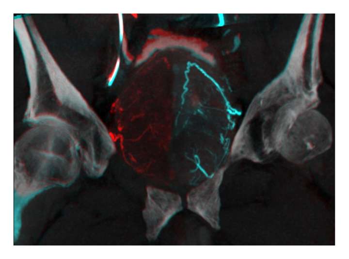 Prostate Artery Embolization - Prostate Imaging | UCLA Health