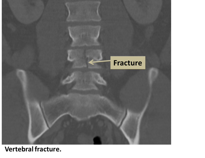 Vertebral Fracture Interventional Radiology UCLA Health