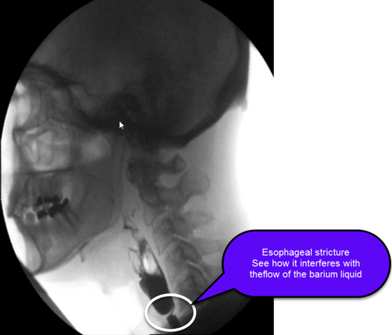 Esophageal Stricture Esophageal Health UCLA Health