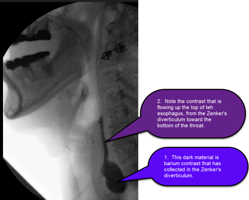 Zenker's Diverticulum Esophageal Health UCLA Health