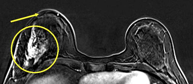Case: Skin and Nipple Changes Figure 7