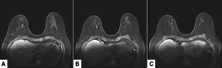 Case: Invasive Lobular Carcinoma Figure 6