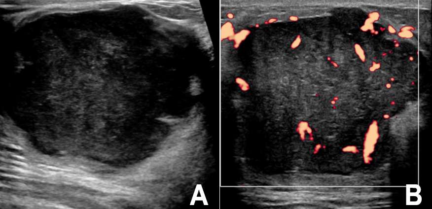 Case: Breast Sarcoma Figure 2