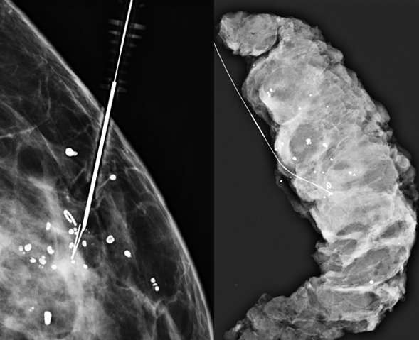 Procedure Mammographically Guided Wire Localizations Figure 4