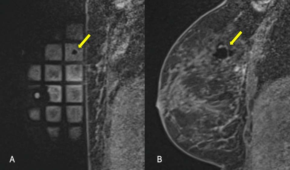 Procedure MRI Guided Breast biopsy Figure 3