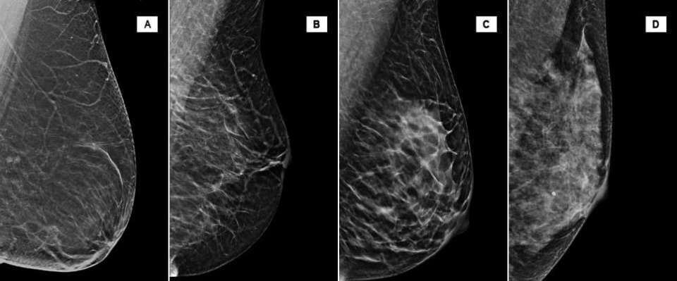 Breast Composition: The Impact of Dense Breasts - Radiology