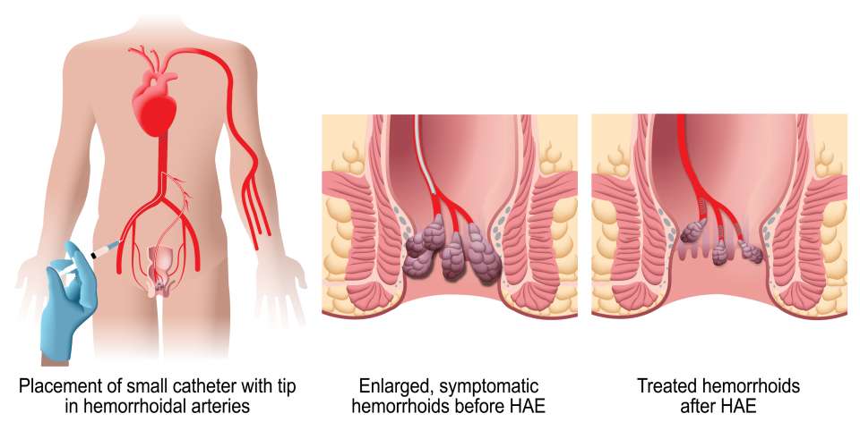 HAE Pre and Post Procedure                                       
