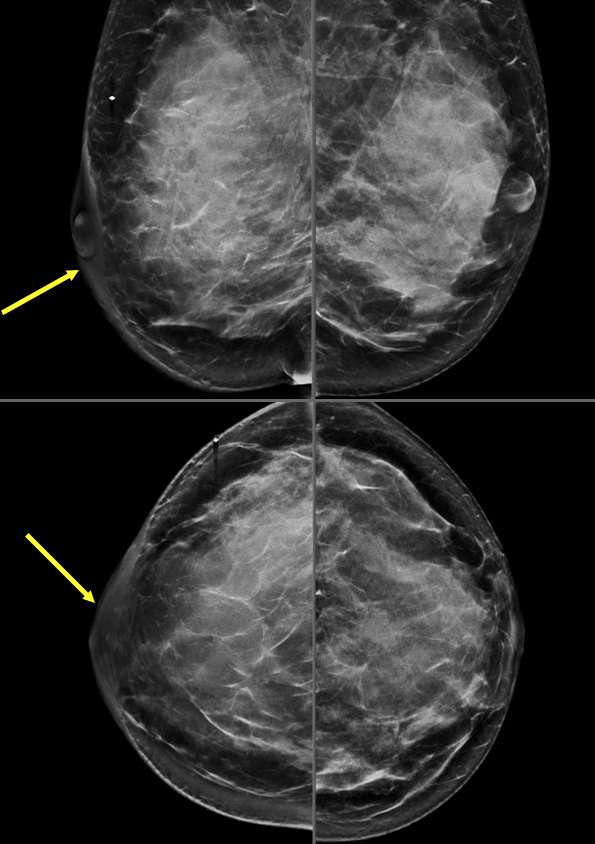 Case: Skin and Nipple Changes Figure 6