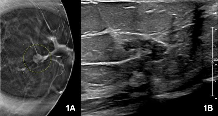 Case: Papillary Carcinoma Figure 1