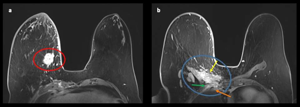 Case: Chest Wall Invasion Figure 2