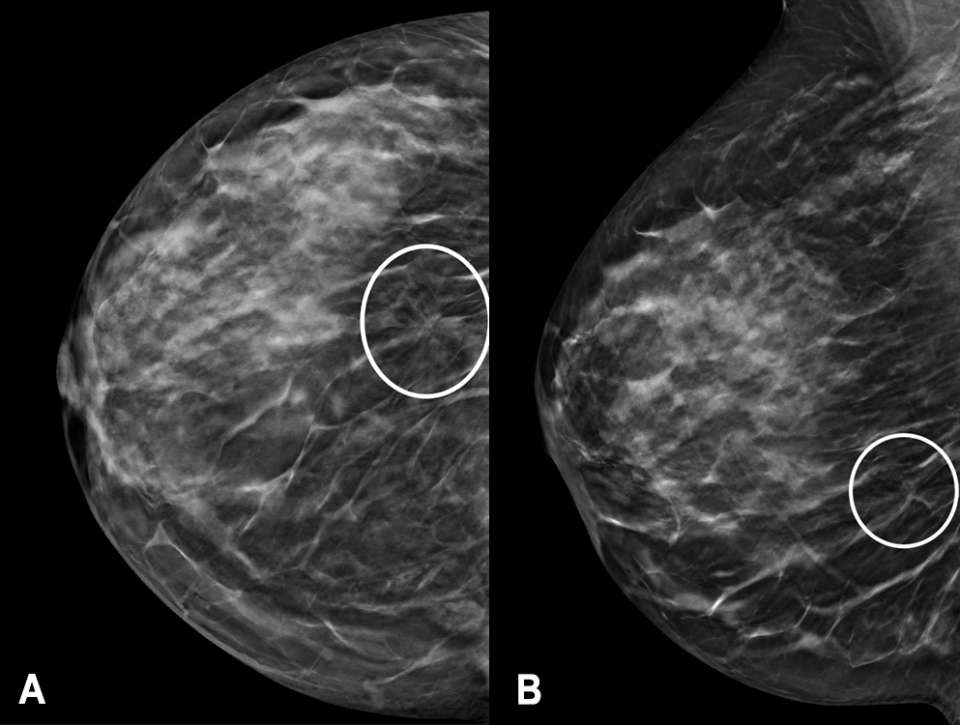 Mammogram images A and B showing circled areas of potential concern.