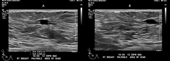 Case: Fat Necrosis of Breast Figure 1