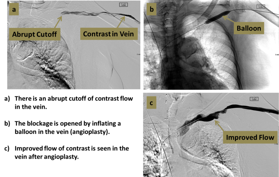 Dialysis Fistula/Graft Interventions Interventional Radiology UCLA