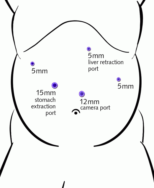 Gastric Sleeve Illustrations - Bariatric Surgery | UCLA Health
