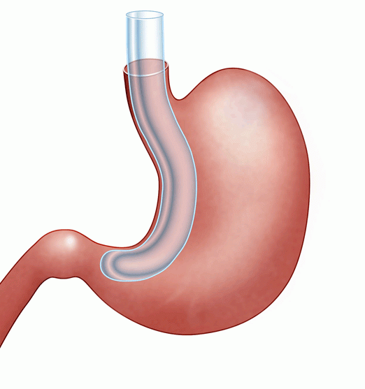 Gastric Sleeve Illustrations - Bariatric Surgery | UCLA Health
